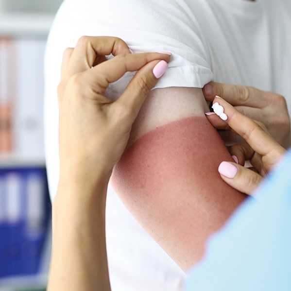 Behandling av solbränd hud. Foto.