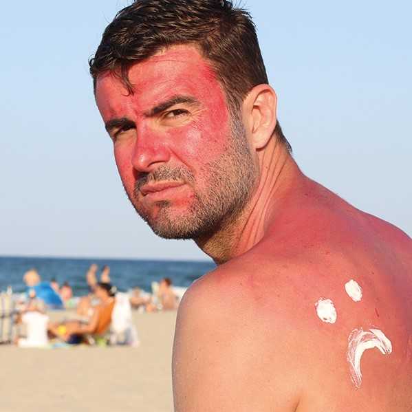 Man med röd solbränna en solig dag på stranden. Foto.