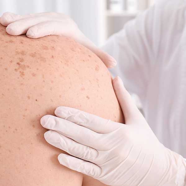 Vårdpersonal kontrollerar märken på huden. Foto.