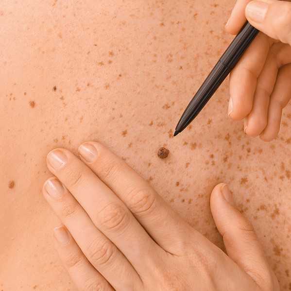 Undersökning av huden. Foto.