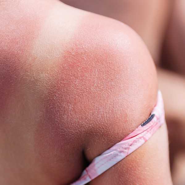 En bränd axel. Foto.